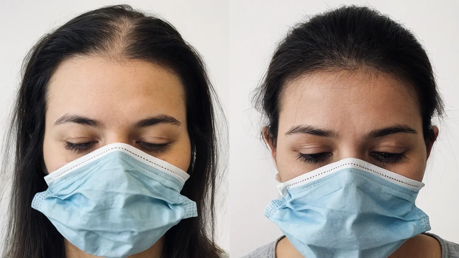 Effet densité cheveux clairsemés