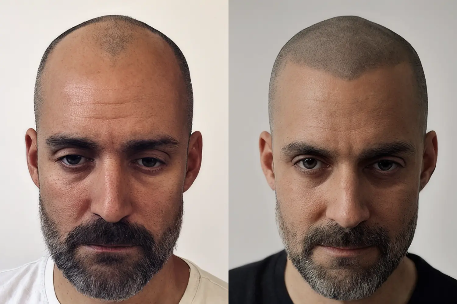 Effet rasé pigmentation capillaire