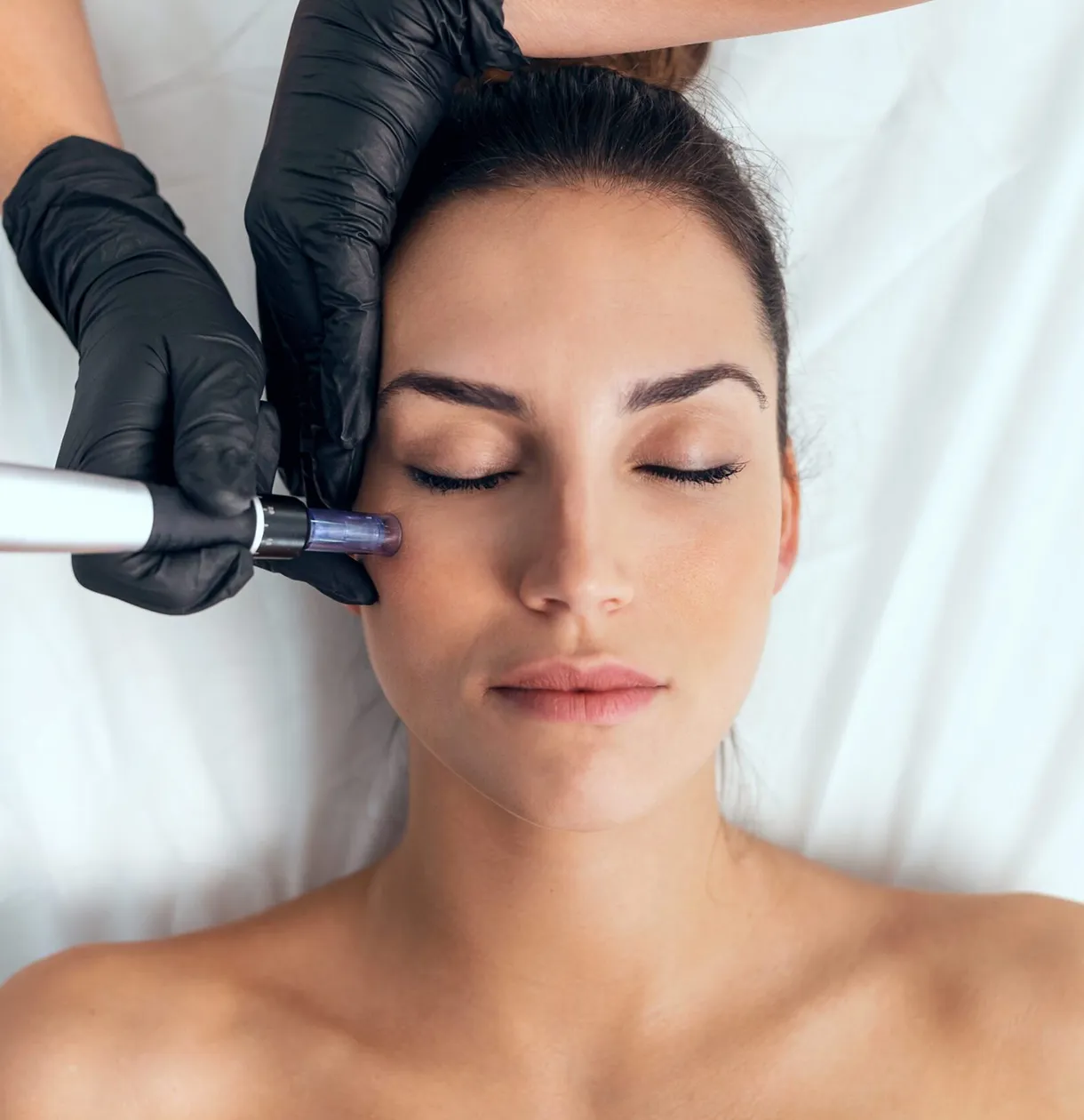 Microneedling chez Eyelight